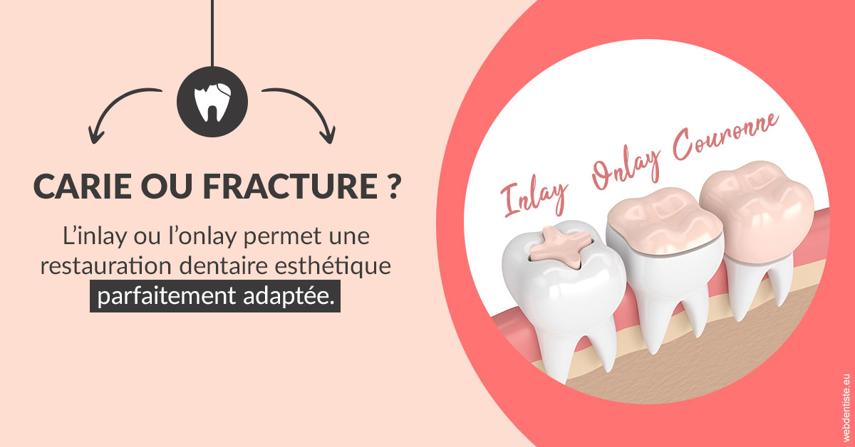 https://dr-alexandre-grau.chirurgiens-dentistes.fr/T2 2023 - Carie ou fracture 2
