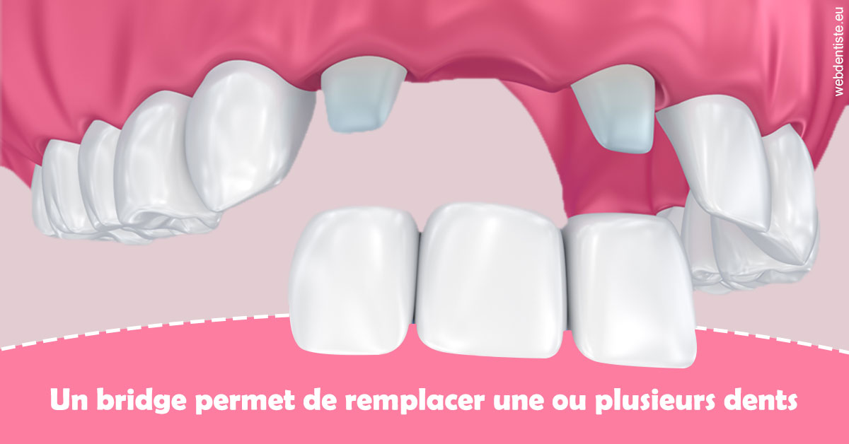 https://dr-alexandre-grau.chirurgiens-dentistes.fr/Bridge remplacer dents 2