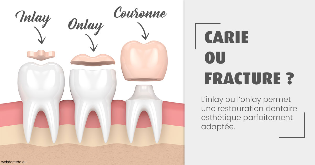 https://dr-alexandre-grau.chirurgiens-dentistes.fr/T2 2023 - Carie ou fracture 1