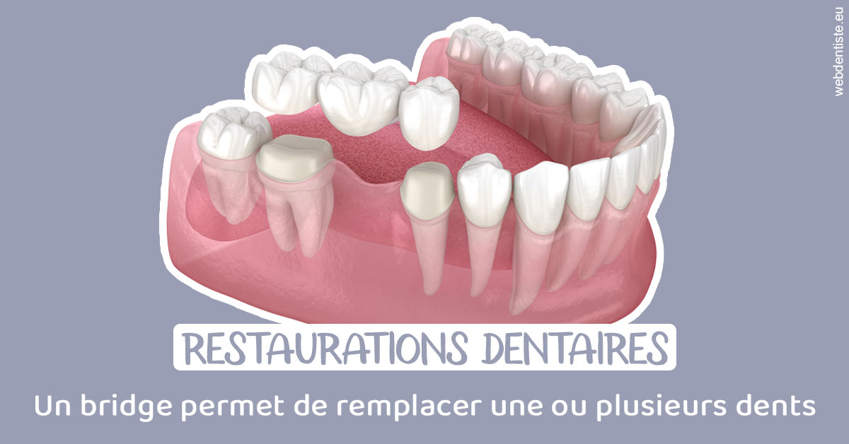 https://dr-alexandre-grau.chirurgiens-dentistes.fr/Bridge remplacer dents 1