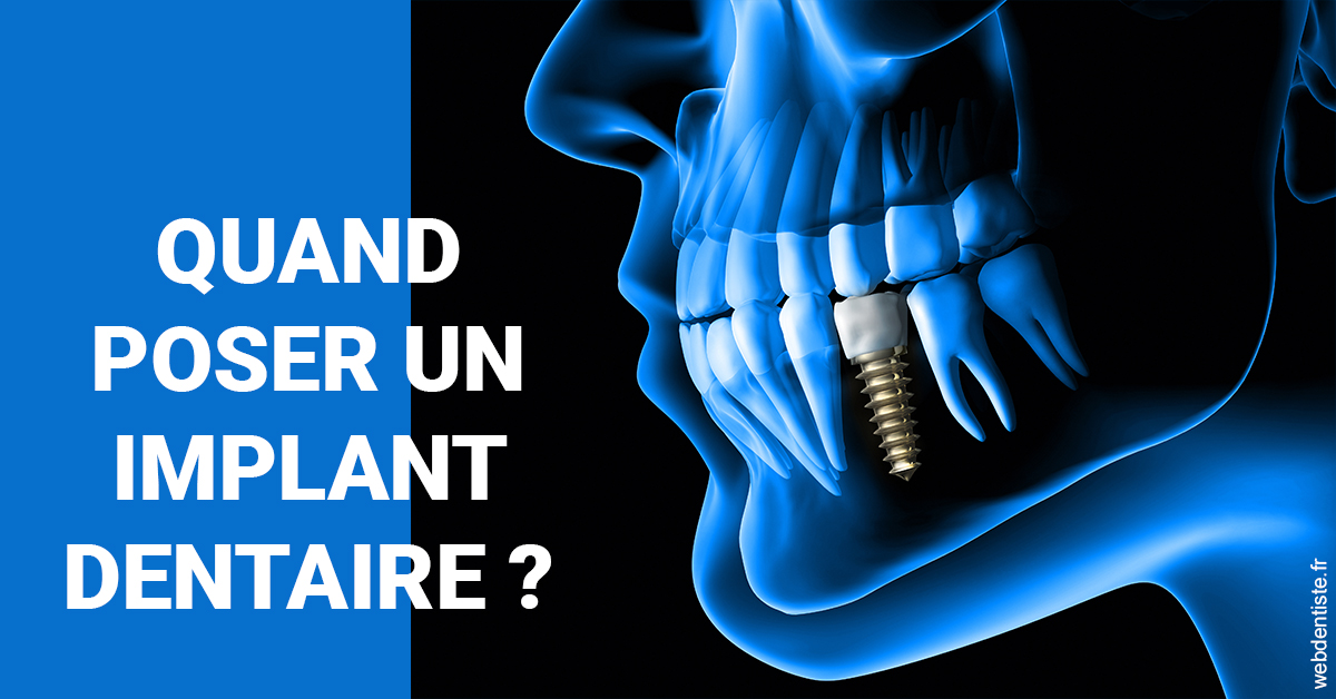 https://dr-alexandre-grau.chirurgiens-dentistes.fr/Les implants 1