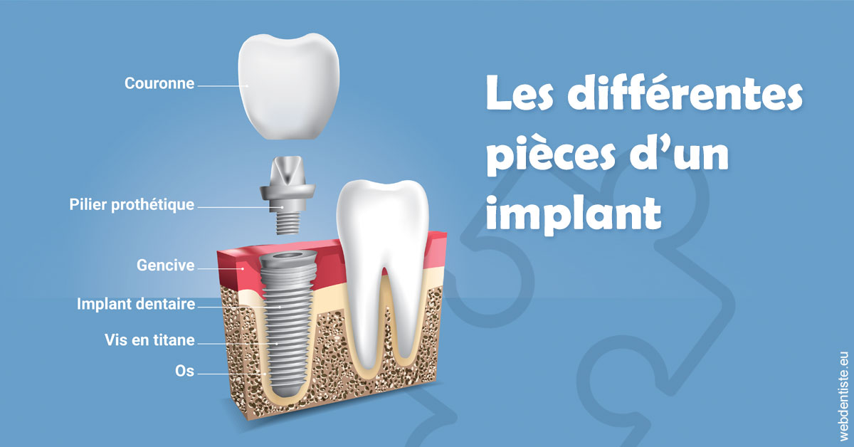 https://dr-alexandre-grau.chirurgiens-dentistes.fr/Les différentes pièces d’un implant 1